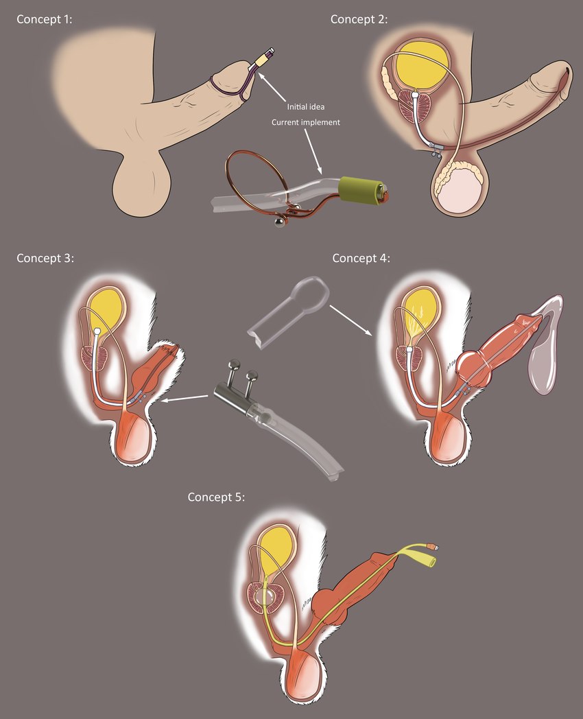 anatomy animal_genitalia anthro balls bathroom_control bladder bodily_fluids catch_condom catheter catheter_in_urethra condom contraption_concept cum cum_in_bladder cum_inside disembodied_penis duo ejaculation erection filled_condom foley_catheter full_bladder fur genital_fluids genitals glans humanoid_genitalia humanoid_penis knot male medical_instrument organs penetration penis penis_tip prostate retrograde_ejaculation scientific_instrument sexual_barrier_device sheath sounding_rod urethral urethral_penetration urethral_piercing urine urine_in_bladder vein veiny_penis wearing_condom white_body white_fur xray_view kanrei mono_(mononatriumglutamat) canid canine human mammal absurd_res biological_illustration concept_art hi_res medical_illustration technical_illustration